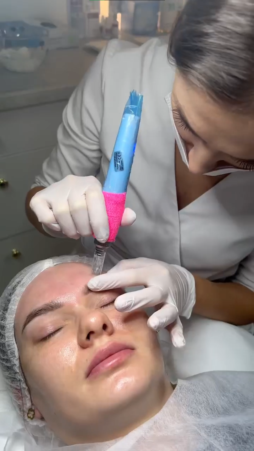 Kosmetyczka w rękawiczkach wykonuje mezoterapię mikroigłową na czole klientki leżącej w jednorazowym stroju ochronnym.